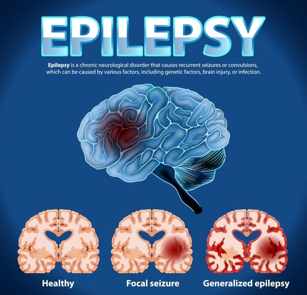 A graphic design describing epilepsy